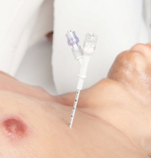 Dekompresní jehla Russell Pneumofix 12G