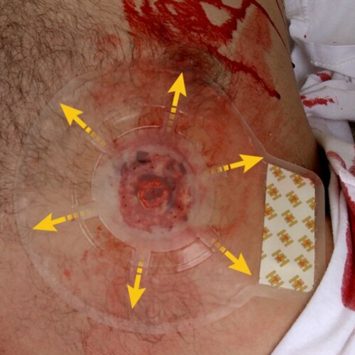 H*VENT chest seal - hrudní chlopeň s ventilem