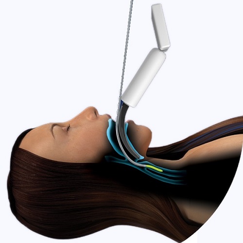 Flexible Tip Bougie - zavaděč ET rourek