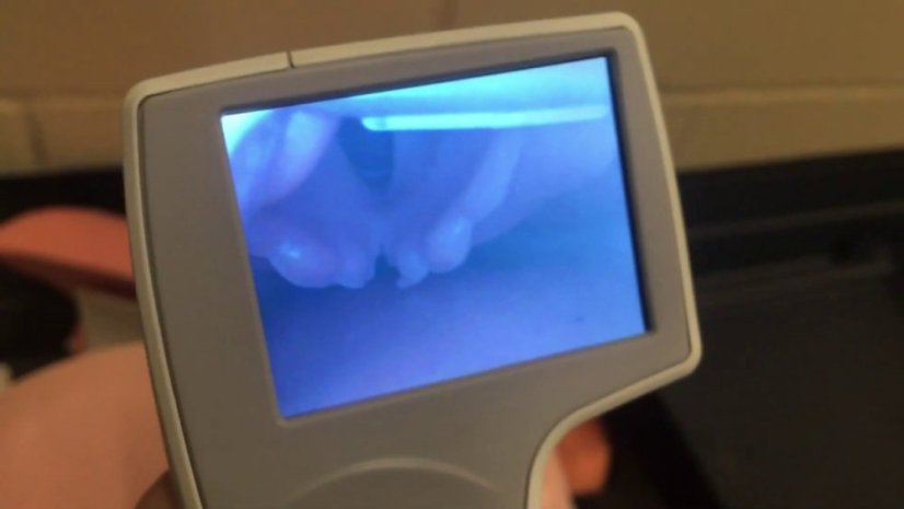 I-VIEW - jednorázový videolaryngoskop